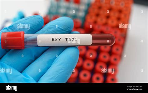 The HPV Test 